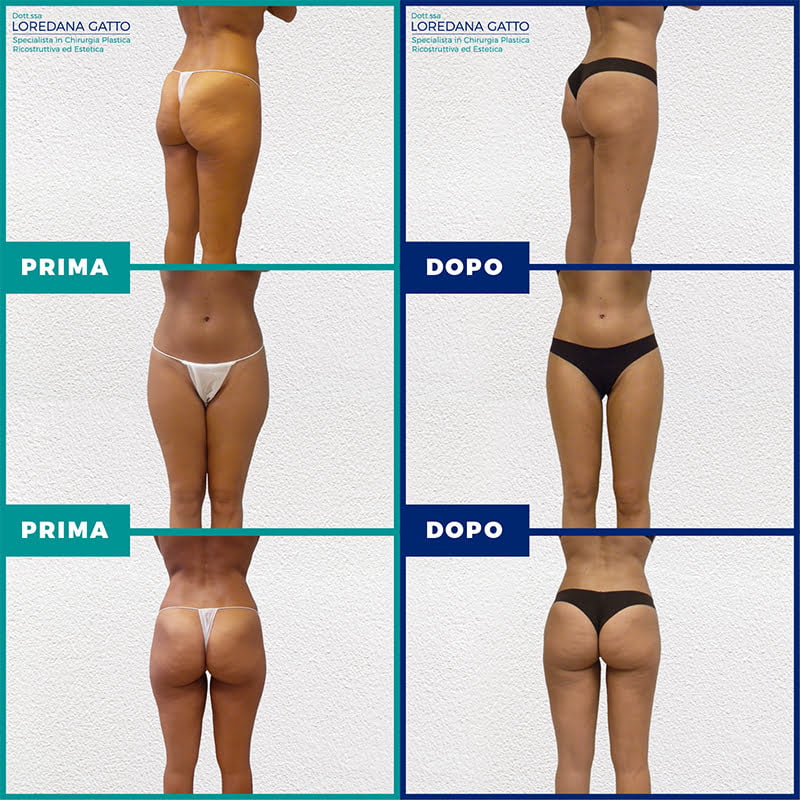 liposuzione-non-chirurgica