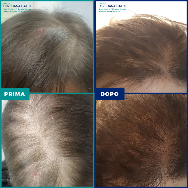 prp-capelli