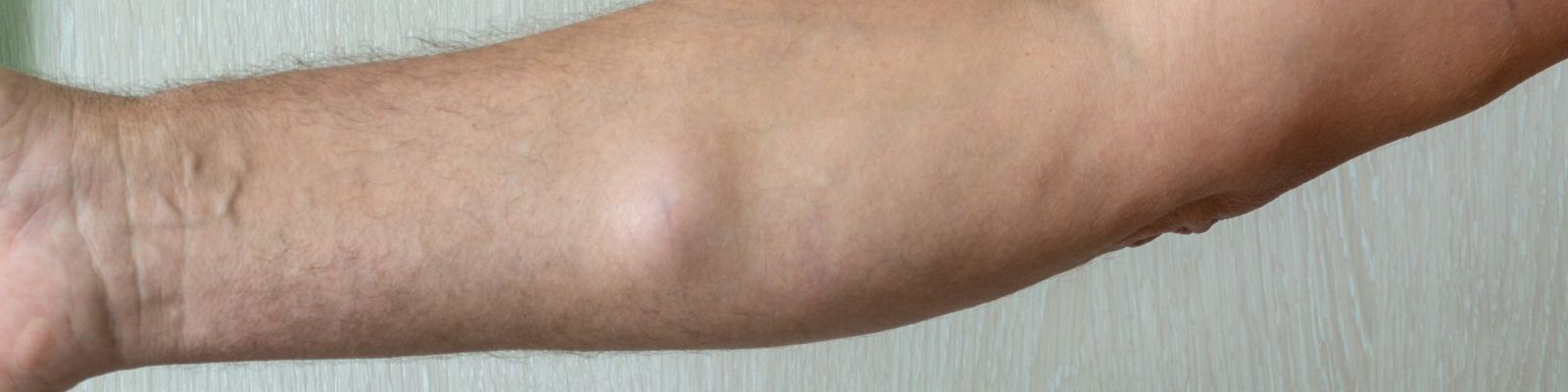 avambraccio con lipoma sotto cute