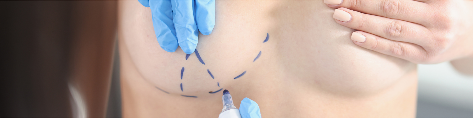 seno della donna coperti dalle mani del medico e della donna con i disegni preoperatori