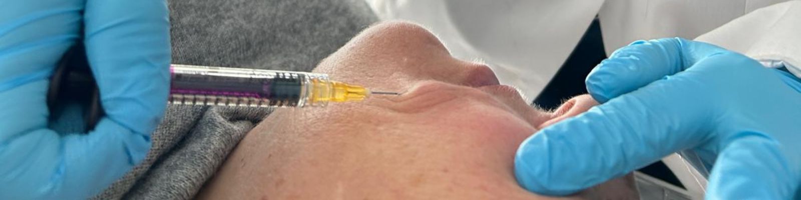 siringa inserita sottocute nel viso femminile